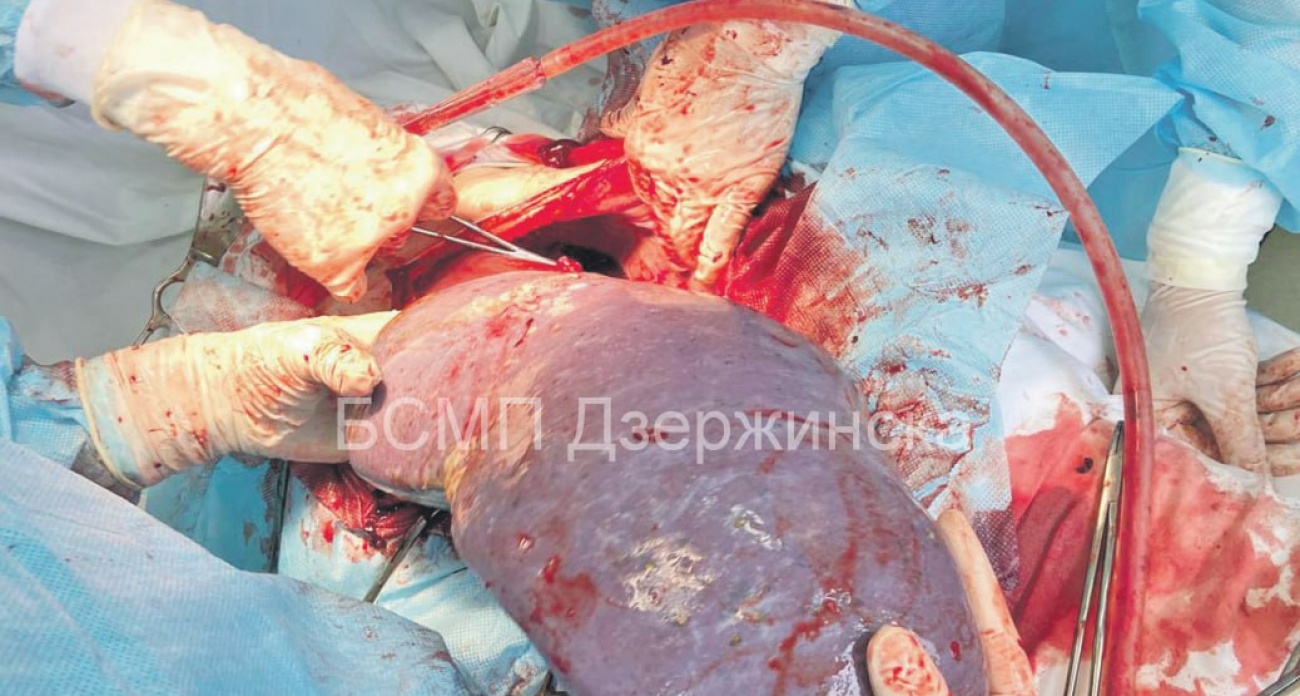 В Дзержинске врачи впервые удалили селезенку размером в четыре раза больше нормы